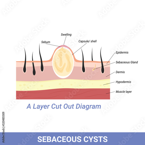 Sebaceous Cyst or other skin and follicle problems illustration