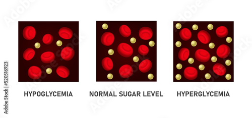 Glucose Blood Sugar Level Set. Hypoglycemia and Hyperglycemia Icons. Vector