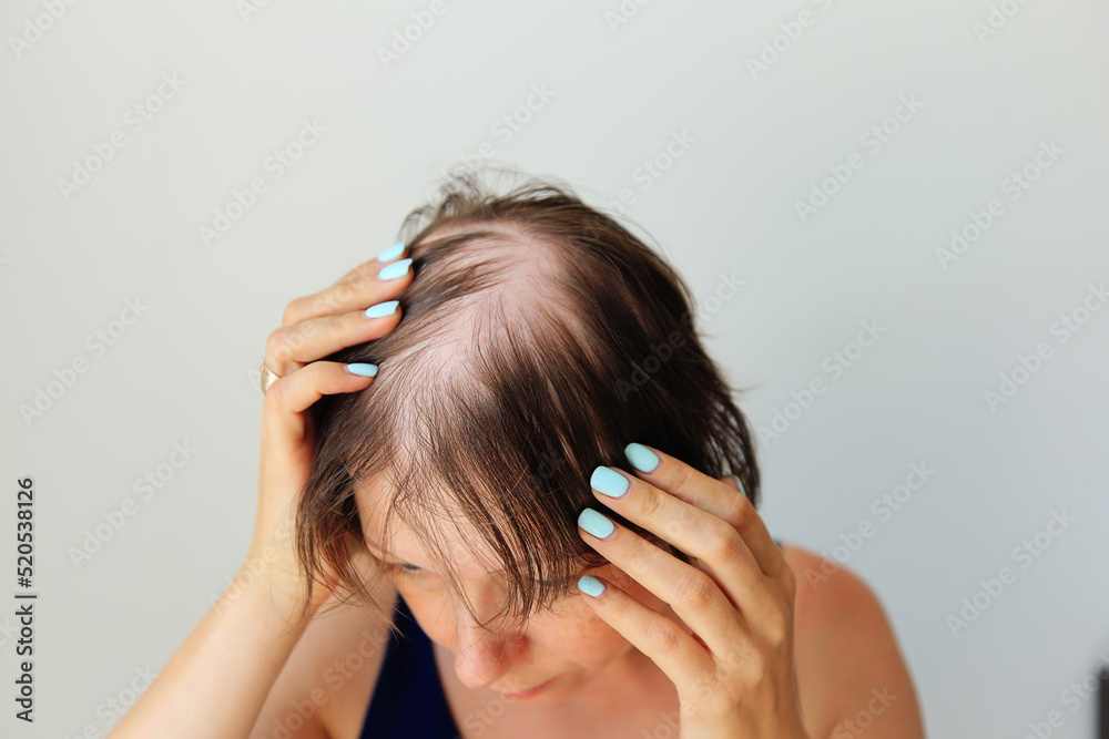 Hair loss in the form of alopecia areata. Bald head of a woman. Hair thinning after covid. Bald patches of total alopecia - obrazy, fototapety, plakaty 
