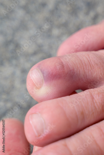 Close up detail of a broken toe of a senior man © michaelheim