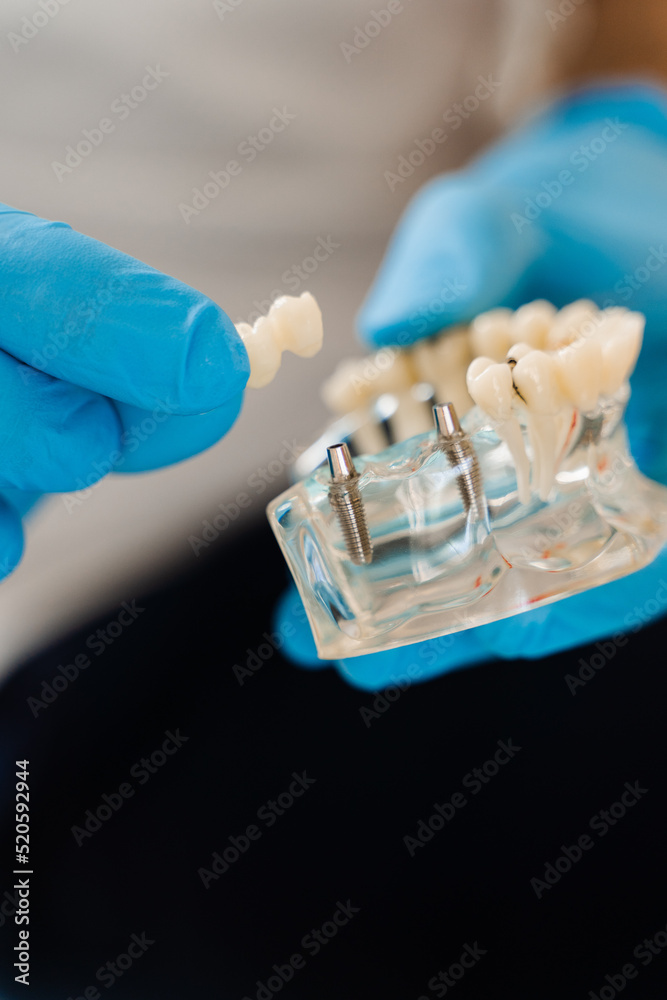 Artificial plastic jaw with dental implants close-up. Dental prosthetics and implants. Dental prosthetics consultation with dentist for patient woman in dentistry. Artificial plastic jaw with dental implants close-up. Dental prosthetics and implants. Dental prosthetics consultation with dentist for patient woman in dentistry.