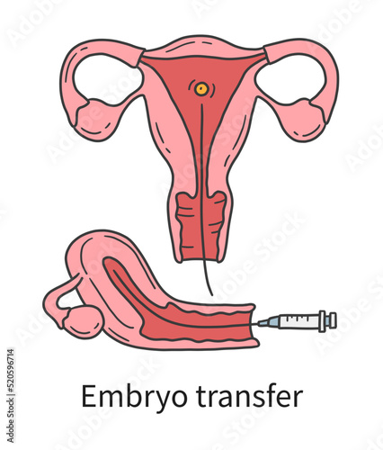 Embryo transfer into a woman's uterus at In Vitro fertilization IVF vector illustration in doodle hand drawn style