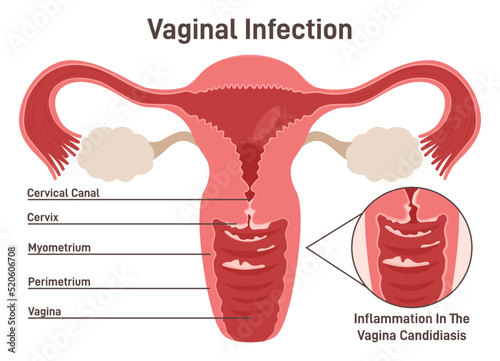 Female reproductive system. Vaginal yeast infection are due to excessive