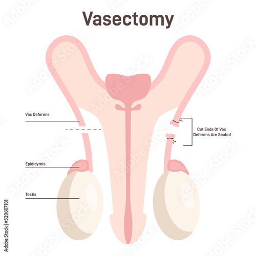 Vasectomy. Surgical procedure for male sterilization. Male reproductive