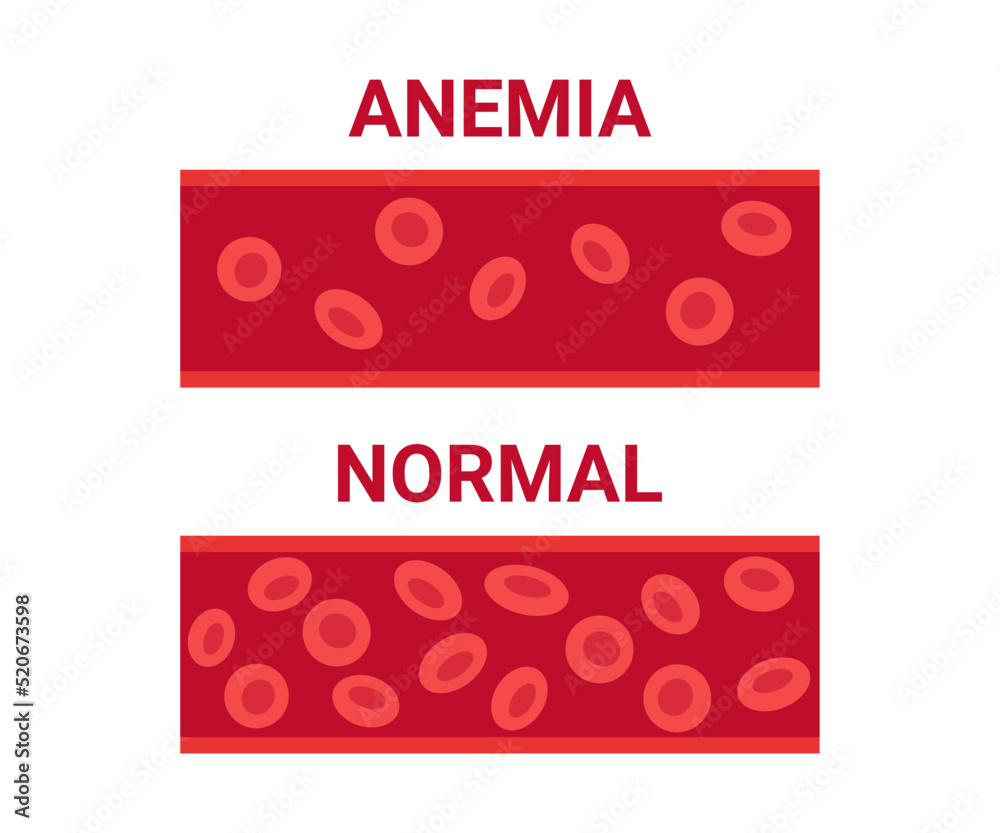 Normal and anemia blood in vessel comparison, number circulation cells