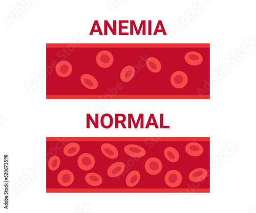 Normal and anemia blood in vessel comparison, number circulation cells erythrocyte. Hemoglobin low level, iron deficiency anemia. Disease anemic blood cells. Health problem. Vector illustration