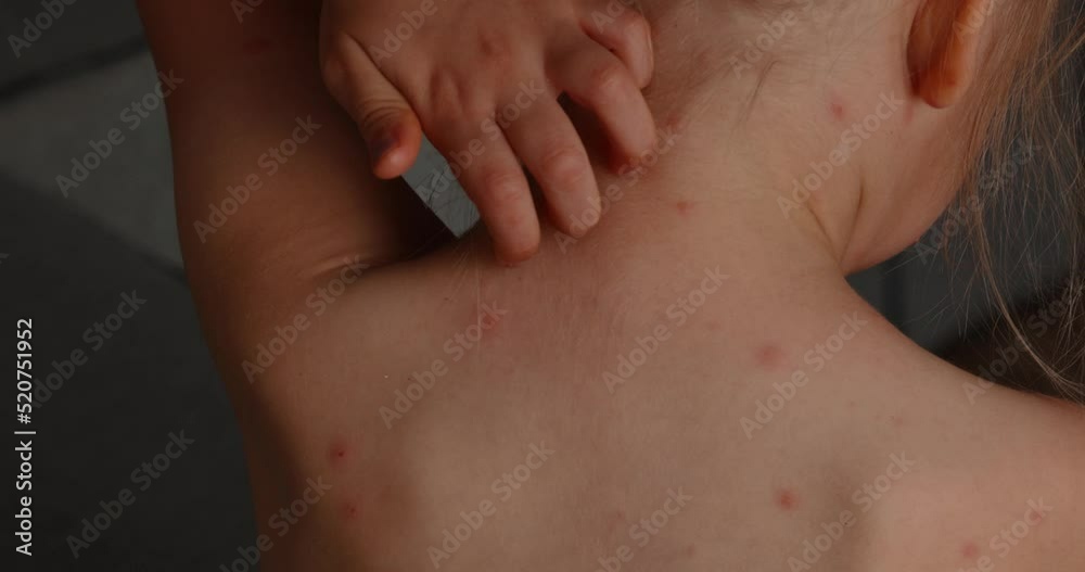 Girl itches, skin rashes. Five-year-old girl with chickenpox, measles, Monkeypox virus.