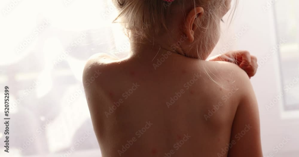 Girl itches, skin rashes. Five-year-old girl with chickenpox, measles, Monkeypox virus.