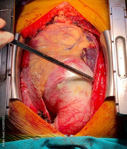 фотографія open heart surgery in patient with ascending aortic aneurysm.
