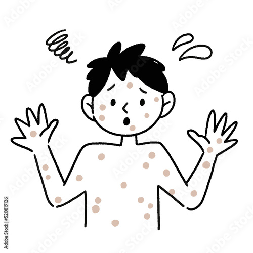 サル痘　男性　イラスト