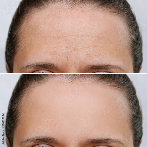 Young caucasian woman with wrinkles on the forehead before and after face lift, botox procedure isolated on a white background. Wrinkling the forehead. Anti-aging treatment. Skin care. Beauty concept