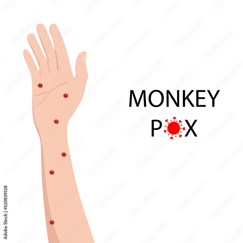 Fototapeta premium symptom of monkeypox on the human hand. Monkey pox