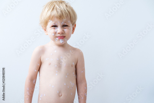 Obraz na plátně portrait of blonde little boy with red rashes Chicken pox virus, varicella with