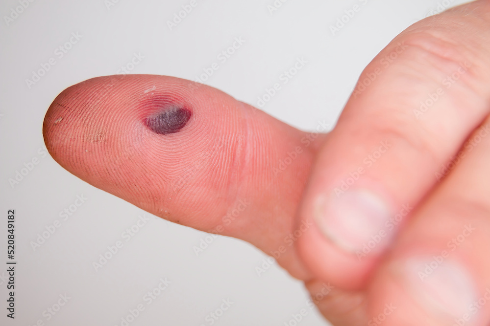 Blister on sale thumb