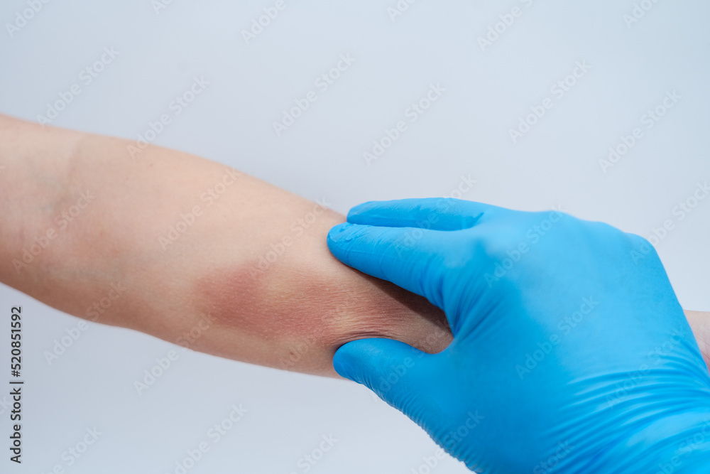 Doctor palpates and examines a large bruise on woman's arm isolated Doctor palpates and examines a large bruise on woman's arm isolated