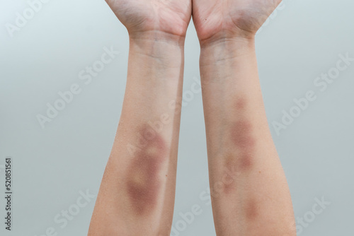 Large bruises on woman's arms isolated on white background