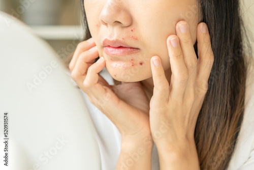 Fotografie Expression worry asian young woman hand touching pustule around the chin and mouth, allergic when wear mask, makeup, show squeezing pimple spot from face