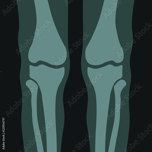 Xray of human body, knees bones and joints vector