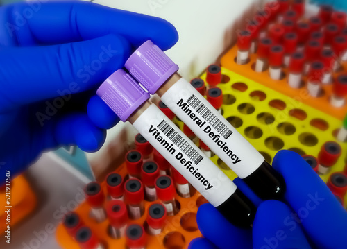 Scientist hold two blood sample one is order for Vitamin deficiency test another is Mineral deficiency test with laboratory background.