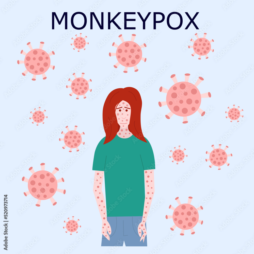 Monkey pox outbreak vector virus illustration. Monkey pox infographic