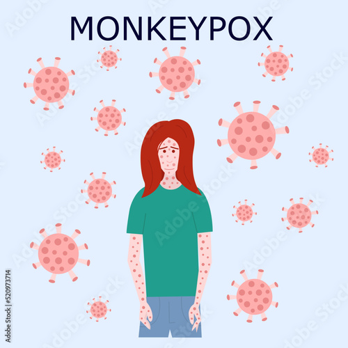 Monkey pox outbreak vector virus illustration. Monkey pox infographic on patient flat illustration photo