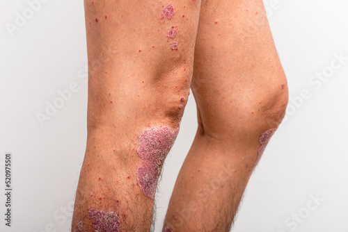 Psoriasis is that knee on white background.