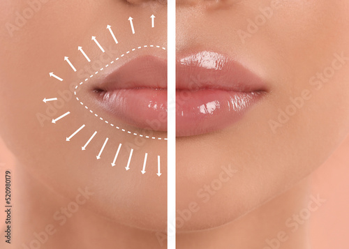 Collage with photos of young woman before and after lips augmentation procedure, closeup photo