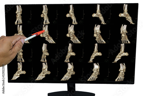  The results of x-ray images of the ankle and found distal tibia bone abnormalities (distal tibiofibular syndesmosis injury) by the doctor pointing to the position on the LCD screen. photo