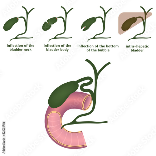 Inflection of the gallbladder. Diagram with varieties of organ pathology. Medical poster. Vector illustration
