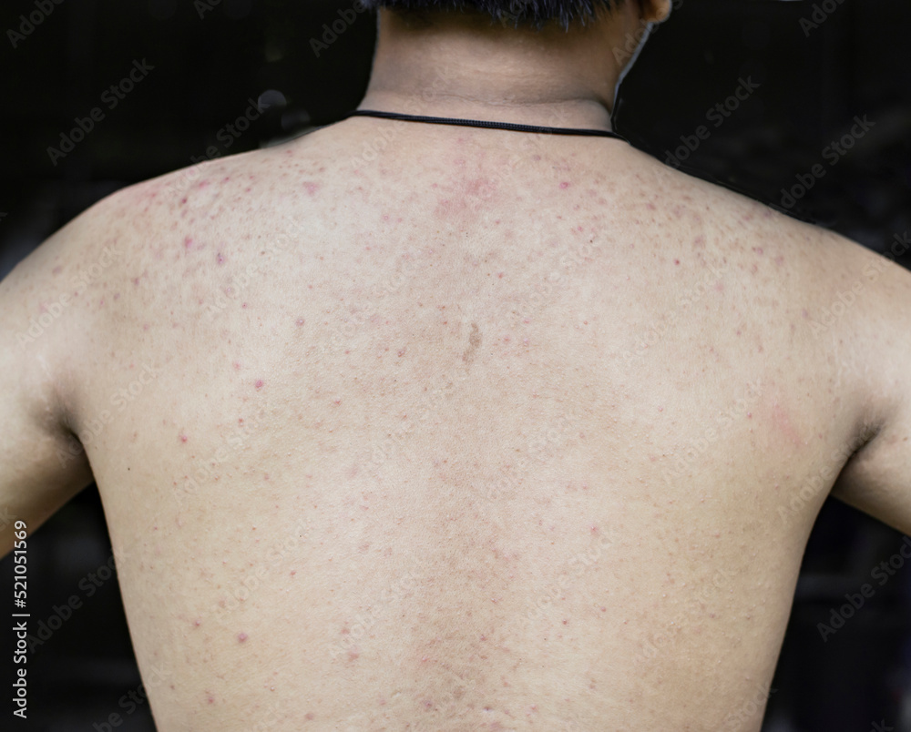 Dermatitis, rash and red bump on the skin on a person's body Stock ...