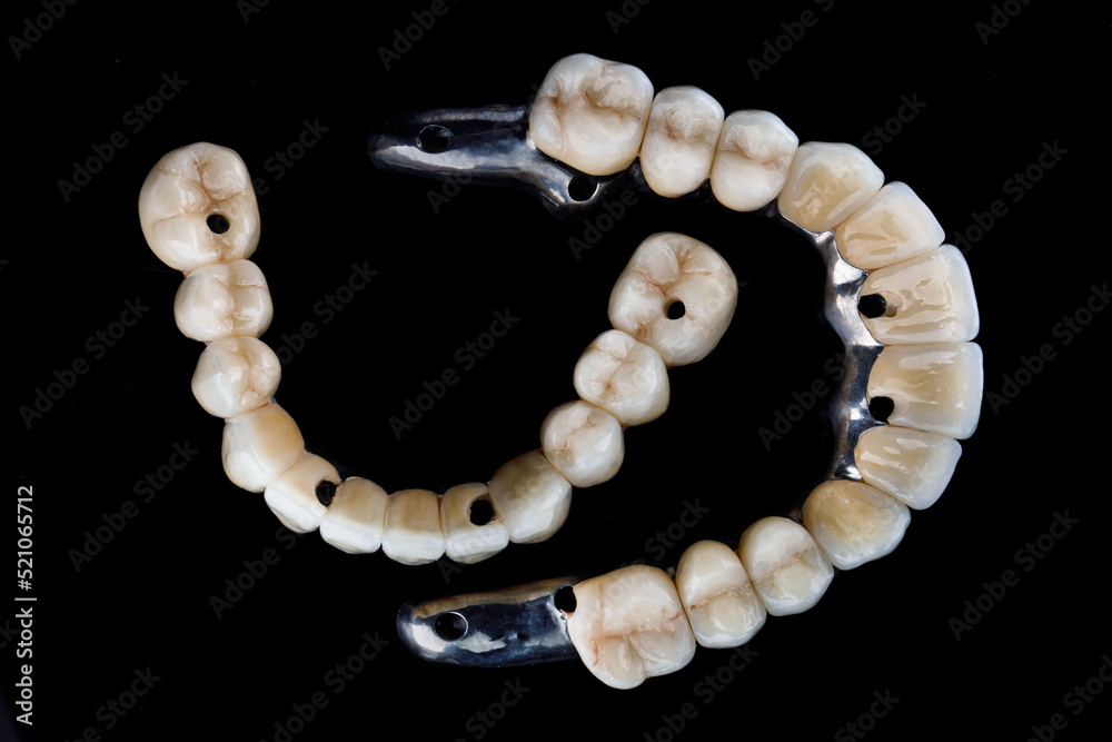 two dental prostheses on titanium beams, top view on a black background two dental prostheses on titanium beams, top view on a black background