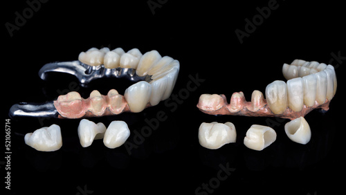 two dental prostheses on titanium beams and ceramic crowns on a black background