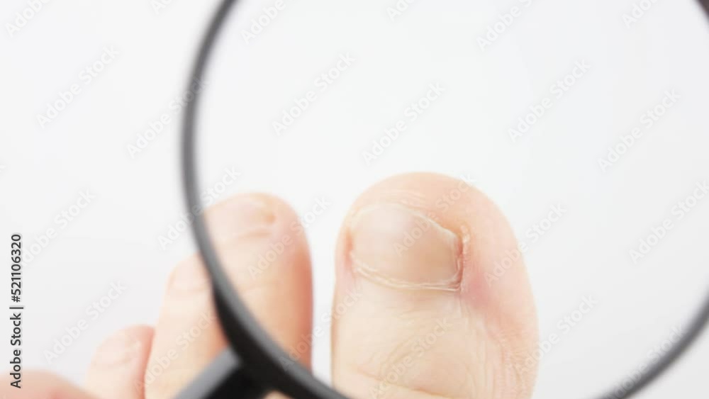 Nails, toes of a man. Review, inspection of toenails.