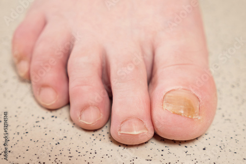 Toenails of woman with fungal infection. Brown bruise under nail of big toe. Senior woman touches injured toenail by index finger, extreme closeup
