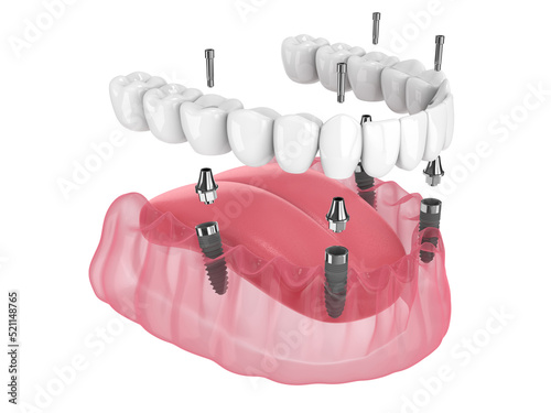 Mandibular prosthesis all on 4 system supported by implants photo
