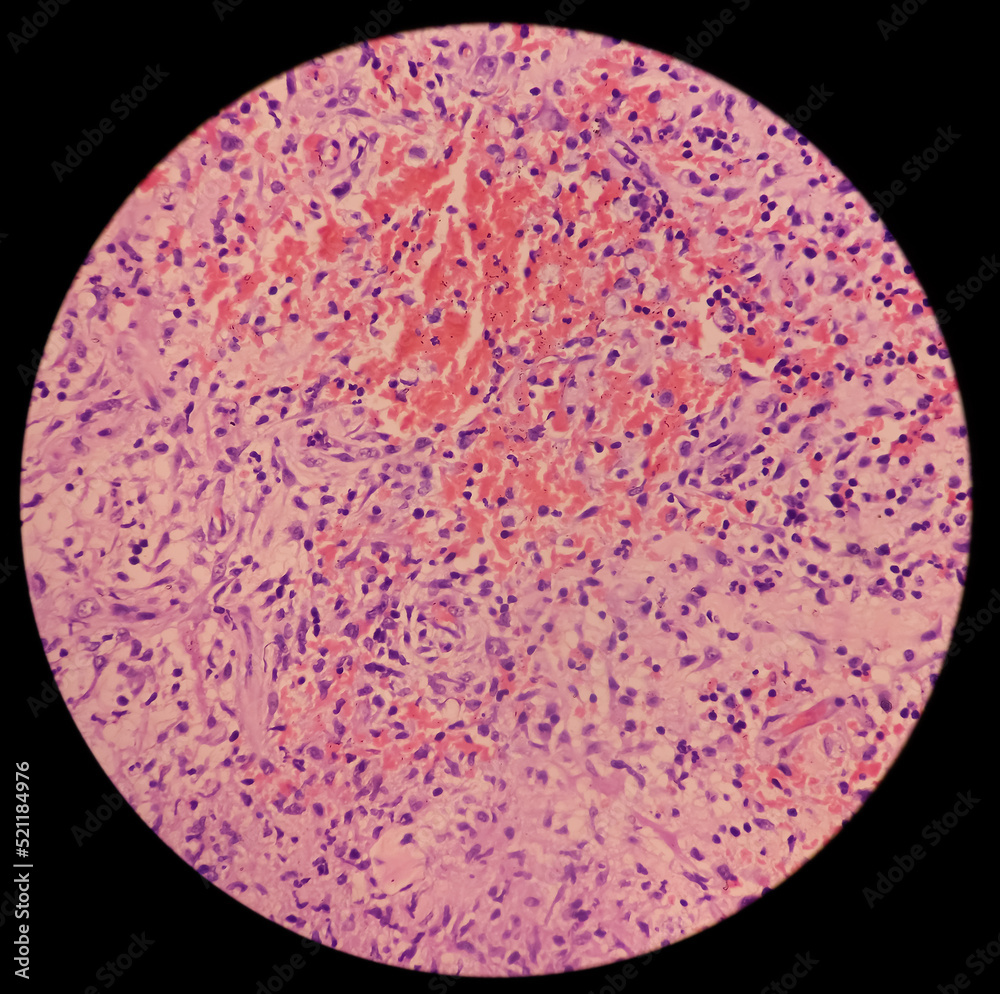 Granulomatous Inflammation With Tuberculosis. Microscopic Show 