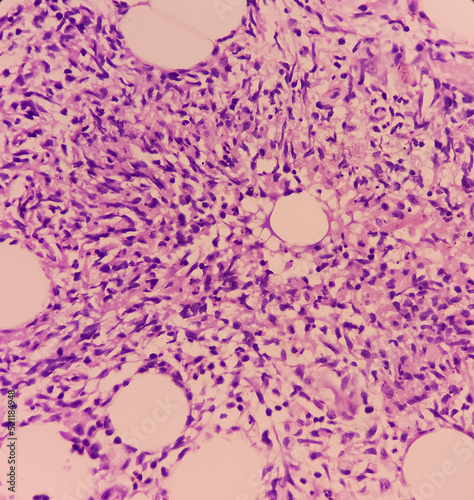 Granulomatous inflammation with tuberculosis. Microscopic show fibrofatty tissue, acute and chronic inflammatory cells and stellate granuloma. Axillary abscess histology.