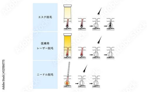 脱毛のイメージ、エステ脱毛・医療用レーザー脱毛・ニードル脱毛