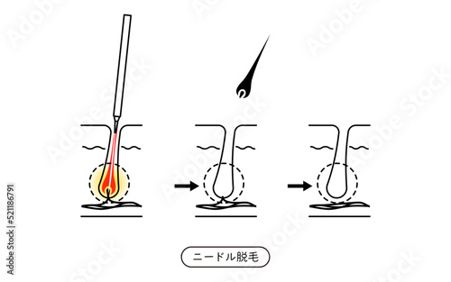 脱毛のイメージ、ニードル脱毛を施術してから毛が抜ける流れ
