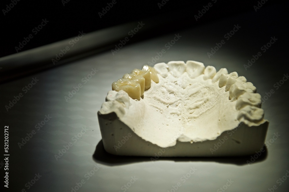 Dental bridge on plaster dental arch, dentistry prosthesis teeth