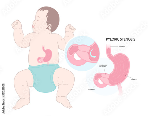 newborn with enlarged Pyloric stenosis in pylorus photo
