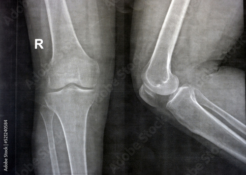 Plain X ray of the right knee shows apparent joint osteoarthritis according to Kellgren and Lawrence system for classification of osteoarthritis with definite osteophytes and join space narrowing