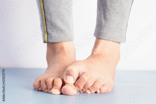 Fotografie Foot fungus, close-up of an itchy woman scratching her toes with her big toes