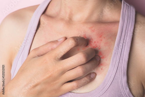 Wallpaper Mural A woman with itching on her chest. rash, allergy, itchy throat, signs of serious disease Torontodigital.ca