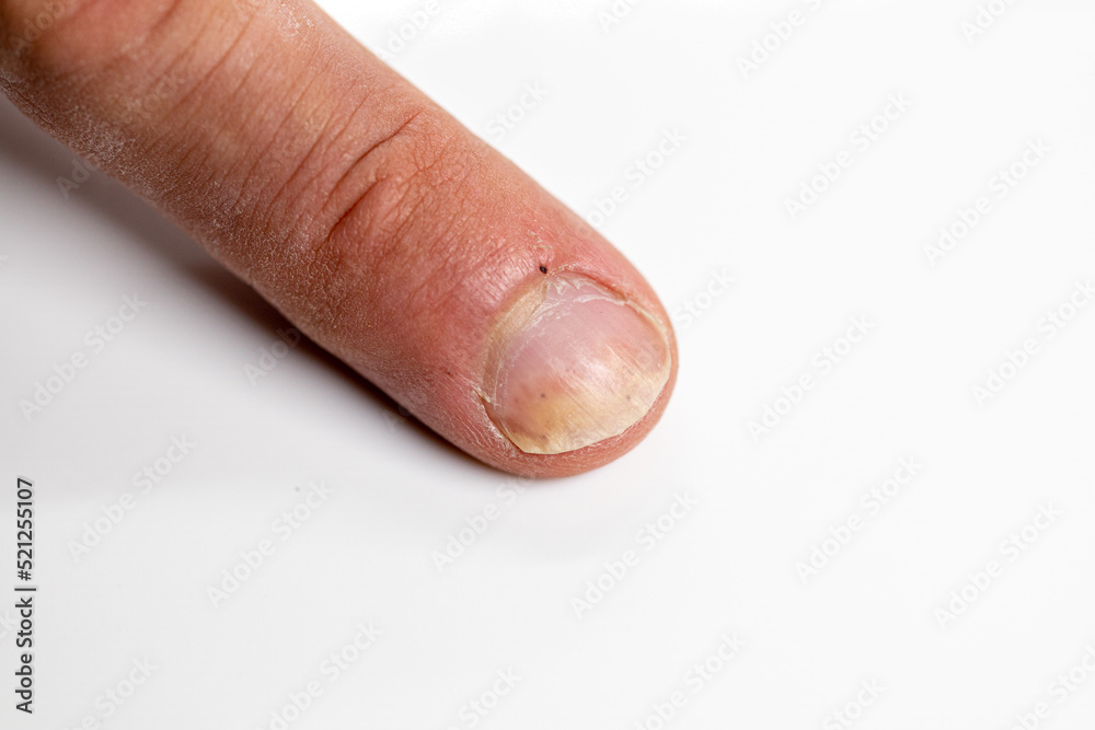 Closeup the ugly skin wound from ingrown toenail problem on woman toe nail  after self pedicure Stock Photo | Adobe Stock