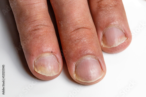 Hand and fingers with Psoriatic onychodystrophy or psoriatic nails. psoriasis unguium. skin problems onychomycosis, tinea. fungal nail infection photo