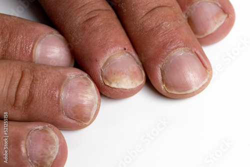 Bild auf Leinwand Hand and fingers with Psoriatic onychodystrophy or psoriatic nails