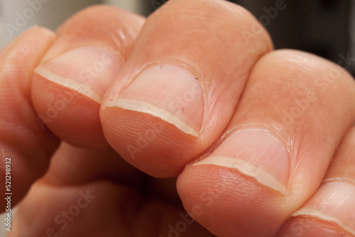 Man whose fingernails need to be trimmed and cleaned