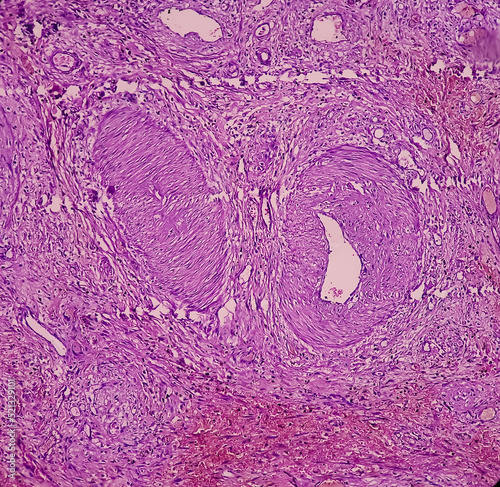 Dermoid cyst, Mature cystic teratoma, show skin, adnexal structure, fatty tissue, salivary acini and cartilage. Cystic teratoma of dermoid cyst. photo