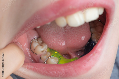Mandibular plate, a boy wears a plate to align his teeth.